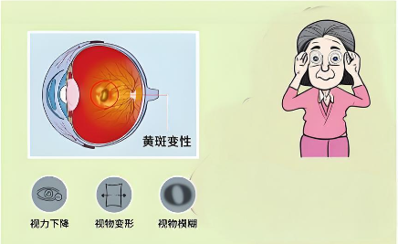 眼底黄斑变性：老年人的视力杀手