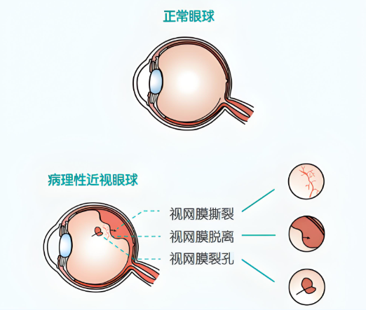 病理性高度近视：不应成为追爱路上的绊脚石