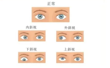 斜视很难自愈！这样干预，视力可以趋于正常……