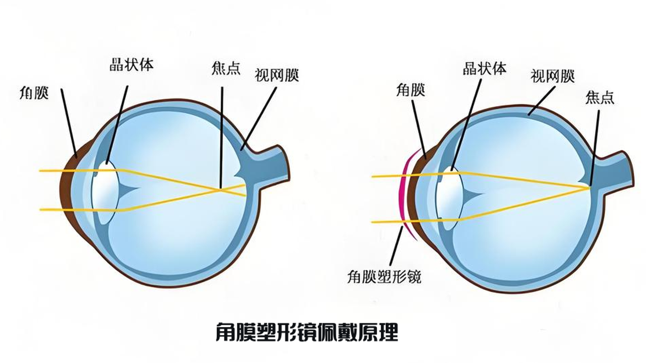 角膜塑形镜：夜间戴镜，白天清晰——它是如何工作的？